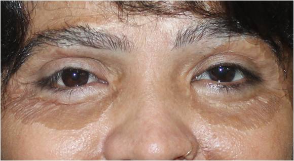 Custom Ocular prosthetics in India